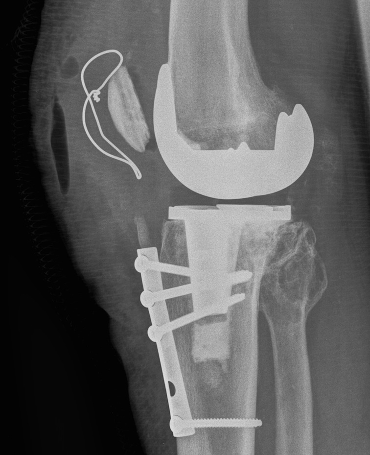 TKA Chronic Quads Rupture Repair